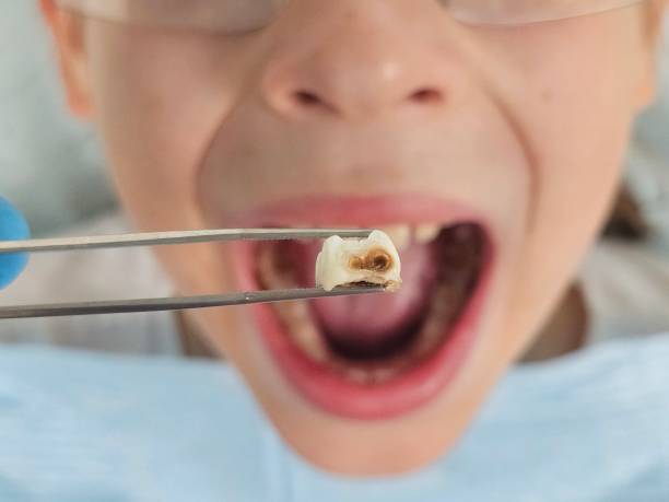 Best Emergency Dentist for Knocked-Out Tooth in Arthurdale, WV