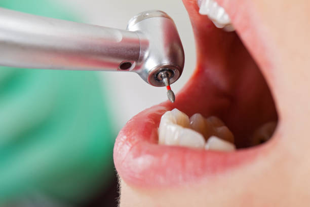 Best Emergency Root Canal Treatment in Arthurdale, WV